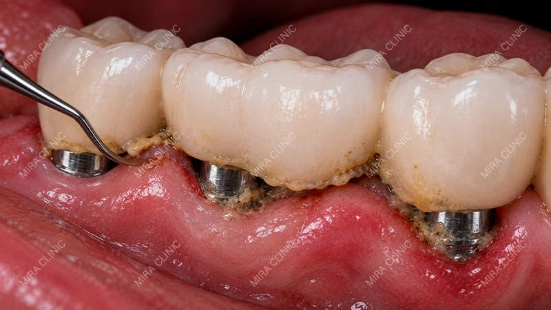 Bacteria Build Up Under an Implant-Supported Bridge